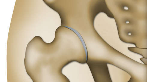 Coxarthrose : la chiropraxie une alternative avant l'opération