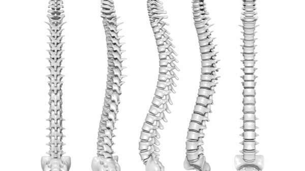 Scoliose : détecter et traiter avec la chiropraxie