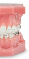 Brackets carrés fixés sur les dents avec arcs métalliques inclus pour traitement orthodontique
