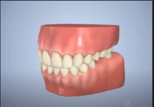 Couronne sur implant dentaire