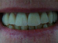 IMPLANTS DENTAIRES : CAS CLINIQUES