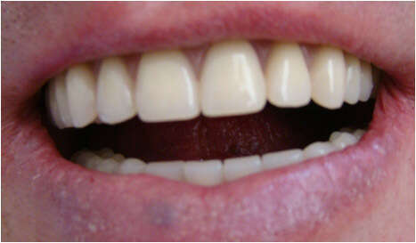 1. PROTHÈSE SUR IMPLANT : RÉHABILITATION COMPLÈTE PAR PROTHÈSE VISSÉE SUR IMPLANTS