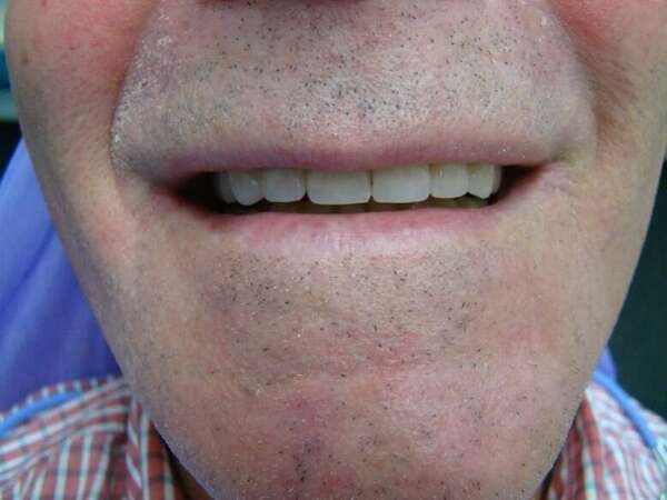 2. PROTHÈSE SUR IMPLANT : RÉHABILITATION COMPLÈTE PAR COURONNE CÉRAMIQUE VISSÉE SUR IMPLANTS