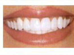 CONSEILS BLANCHIMENT