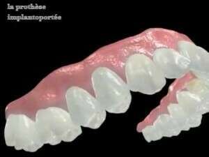 Prothèse implanto-portée