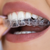 Aligneur orthodontique transparent, orthodontie à Béziers