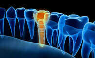 QU'EST-CE QU'UN IMPLANT ? INDICATIONS ET CONTRE-INDICATIONS