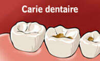 CARIES ET SOINS DES CARIES