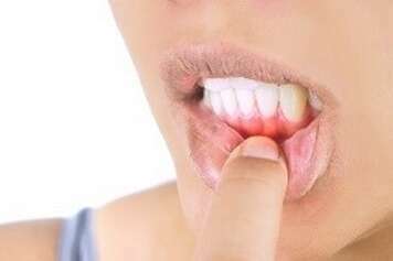 LA MISE EN CHARGE IMMÉDIATE D’UNE PROTHÈSE SUR UN IMPLANT