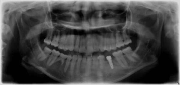 Implants multiples : remplacement de plusieurs racines manquantes