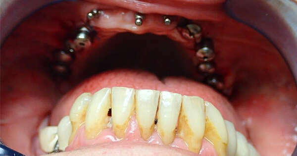 La prothèse supra-implantaire