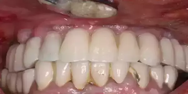 Intérêt des guides à étages dans les extractions-implantations