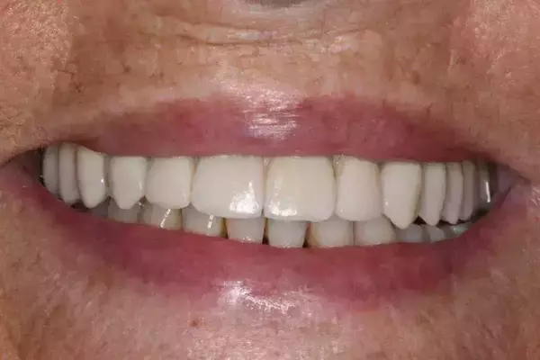 Cas 4 :Bridge céramique supra implantaire de 14 dents vissé sur une barre titane