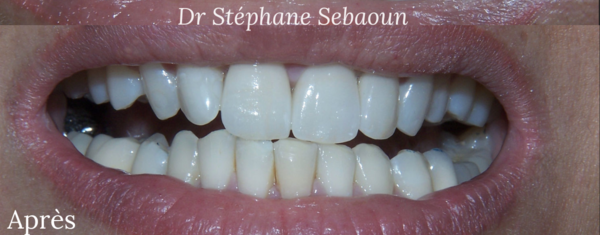 Cas 2 : 4 facettes céramique incisives et canine supérieures et antérieures