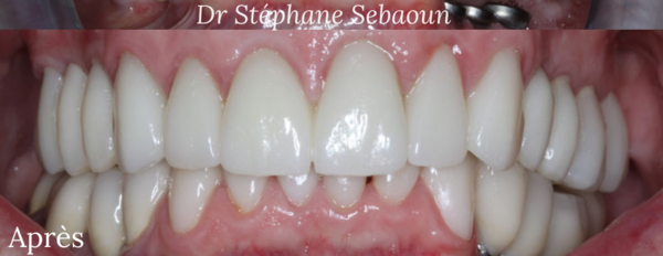 cas 1 : 28 couronnes dentaires en céramique