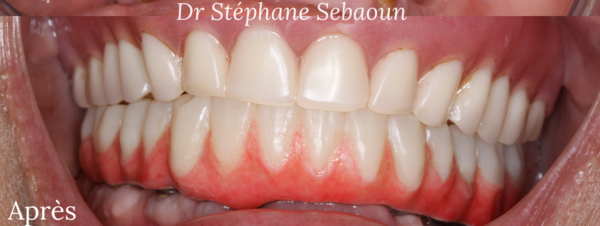 Cas 3 : Prothèse complète résine fixée par 6 implants à la mandibule