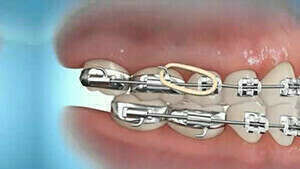 Correction avec élastique classe 3