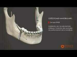 Chirurgie mandibulaire