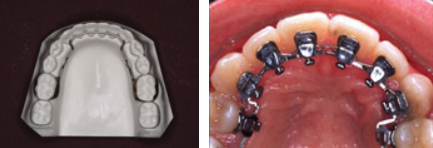 Orthodontie linguale