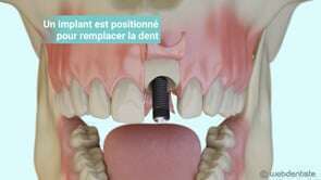 Extraction et implantation immédiate – mise en esthétique directe