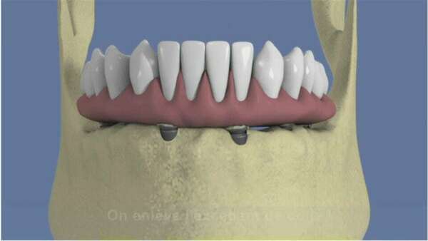 Mandibule complète et traitement implantaire pour un bridge fixe vissé