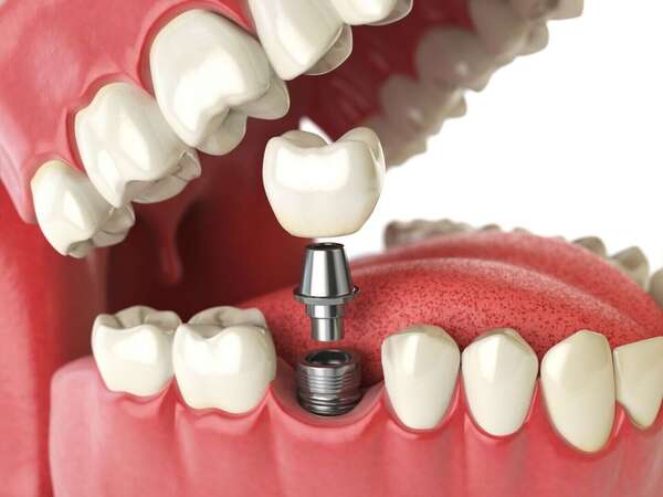 La pose d'implants dentaires