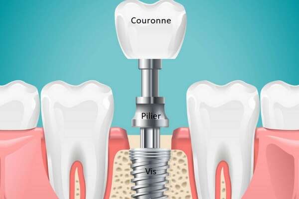 Les différentes pièces d’un implant