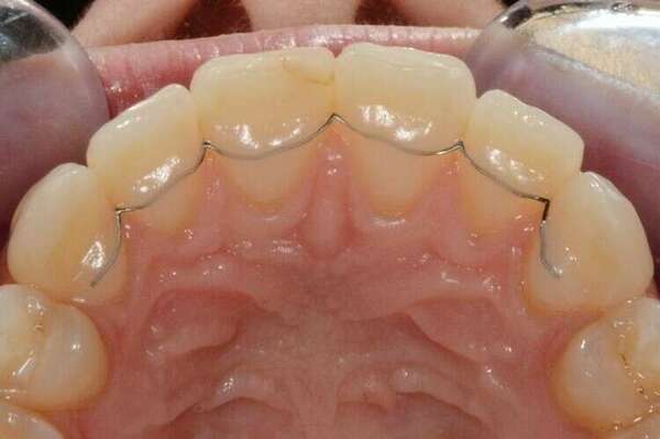 LA PÉRIODE DE CONTENTION ORTHODONTIQUE