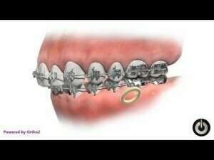Élastique inter-maxillaire