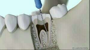 Extraction et comblement osseux