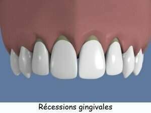 QU’EST-CE QU’UNE RÉCESSION GINGIVALE ?