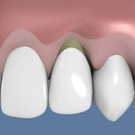 CLASSIFICATION DES RÉCESSIONS GINGIVALES