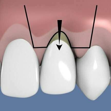 TECHNIQUES DE CHIRURGIE MUCO-GINGIVALES SANS APPORT DE GENCIVE