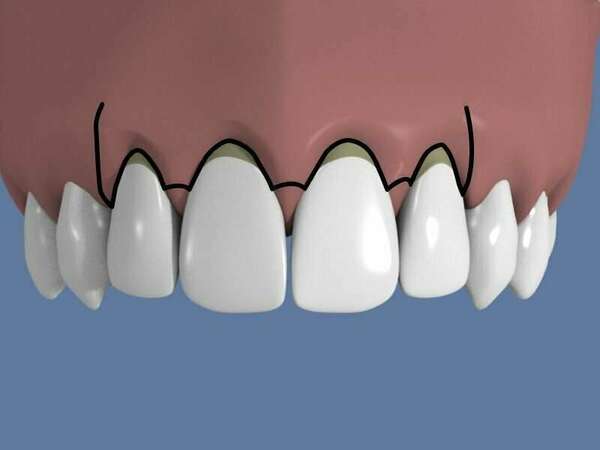 TECHNIQUES DE CHIRURGIE MUCO-GINGIVALES AVEC APPORT DE GENCIVE : LA GREFFE DE CONJONCTIF ENFOUI