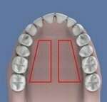 TECHNIQUES DE CHIRURGIE MUCO-GINGIVALES AVEC APPORT DE GENCIVE : LA GREFFE ÉPITHÉLIO-CONJONCTIVE