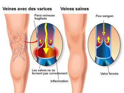 L’insuffisance veineuse