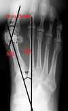 Hallux valgus-alisson-pronier-pedicure-podologue-nandy-savigny-le-temple-carre-senart