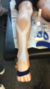 Kinesio-taping Alisson Pronier Pédicure-Podologue