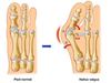 Hallux valgus-alisson-pronier-pedicure-podologue-nandy-savigny-le-temple-carre-senart