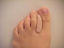 Orthoplastie séparatrice