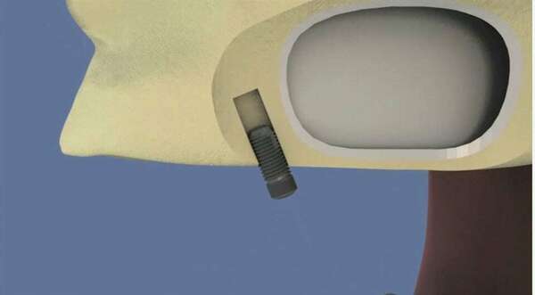 Maxillaire : all-on-4