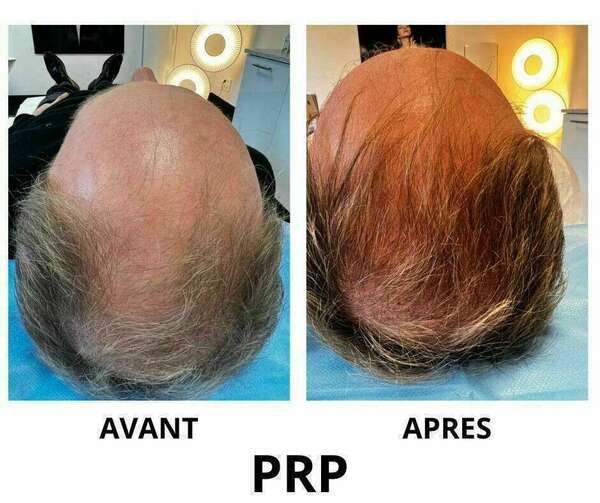 LE PRP