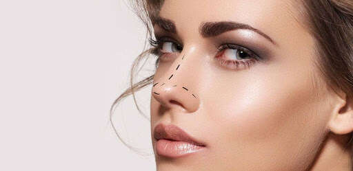 La rhinoplastie sans bistouri