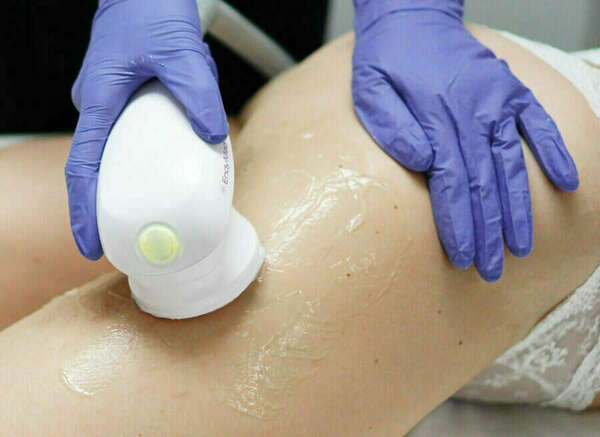 La radiofréquence, c’est quoi ?