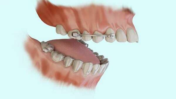 Le dispositif de carrière