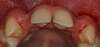 Radiographie montrait poses implants et couronnes dents incisives