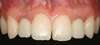 Radiographie montrant pose deux implants dents 12 et 22