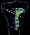 Prothèse de Genou