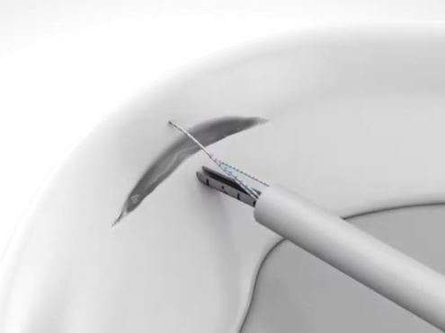 menisques_-_fast_fix_suture_02