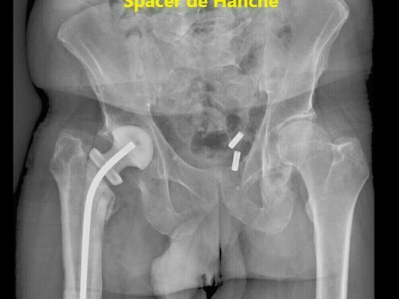 rx_spacer_cardella_1